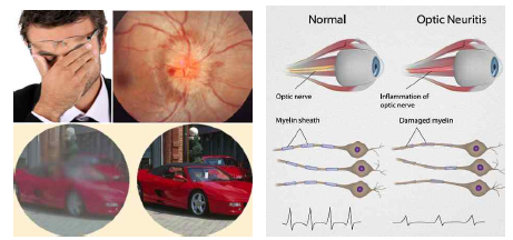 시신경염 (Optic neuritis)