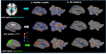 정상인(a)과 AD 환자(b)에서 seed regions(pCIN, precuneus, hippocampus)에 따른 기능적 뇌연결성 변화