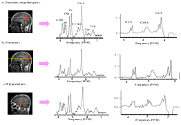 AD 환자에서 얻은 대표적인 스펙트럼: pCIN(a), precuneus(b), hippocampus(c)