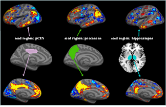 Seed region을 이용한 기능적 뇌연결성: pCIN, precuneus, hippocampus