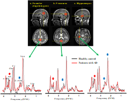 AD와 관련된 부위에서 얻은 스펙트럼: pCIN(a), precuneus(b), hippocampus(c). 빨간선: AD환자, 검은선: 정상인