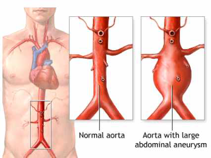 정상 대동맥과 복부대동맥류