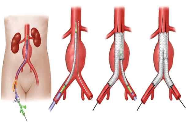 복부대동맥류 스텐트 그라프트