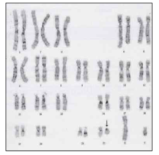 말초혈액 염색체검사에서 22번 ring chromosome 소견