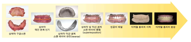 스캔 데이터 반전 및 중첩법을 접목한 디지털 총의치 치료 워크플로우