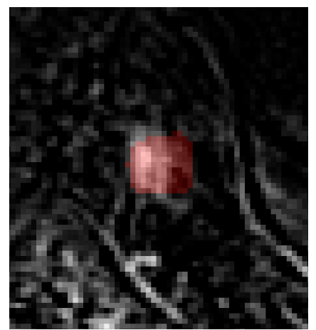 Image of PET MASK overlap on contrast-enhanced MRI