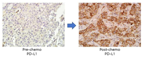 종양조직에서의 PD-L1 발현의 확인 및 치료전후의 변화
