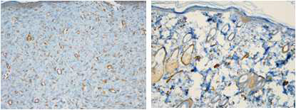 흉터조직(좌)에서 모낭의 유의한 감소 및 α-SMA의 유의한 증가