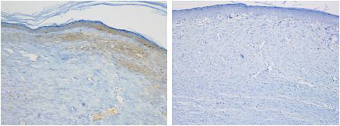 흉터조직(좌)에서 모낭의 유의한 감소 및 Ki67의 유의한 증가