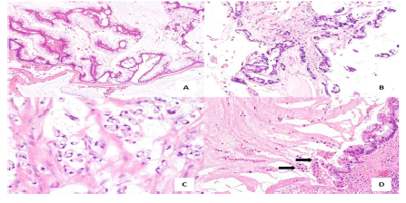 PMP의 각 진단 범주의 대표적인 현미경 사진. A: 골반강 내 LowGrade-PMP, B: HighGrade-PMP, C:mesoappendix의 SRC-PMP, D:유사 인장 고리 세포