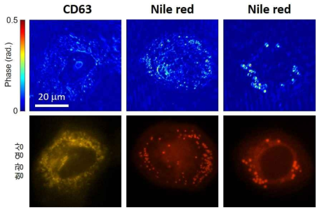 표면 단백질 CD63를 표지한 폐암 세포와 나일 레드에 염색된 폐암 세포의 위상 지연 영상 (위쪽), 형광 영상 (아래쪽)
