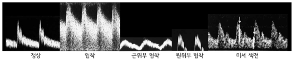 경동맥의 도플러 파형