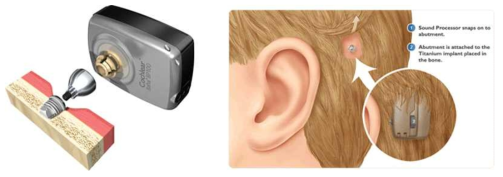 Cochlear사의 BAHA BP100(좌)과 착용 모습(우)