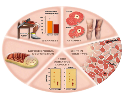 Overview of potential abnormalities in muscle structure and function in patients with COPD