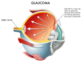 안압의 상승에 의한 시신경의 손상