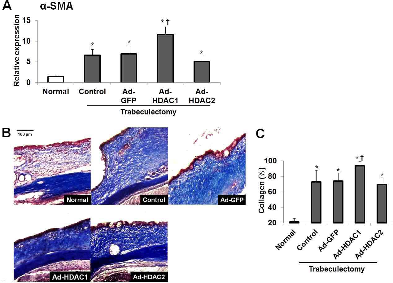 Effects of HDAC1 and HDAC2 overexpression on the expression of a-SMA mRNA and collagen density after trabeculectomy