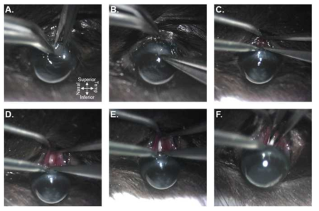 Optic nerve crush injury