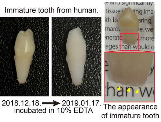 인간 미성숙 치아의 조직투명화 진행
