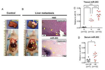 miR-203의 발현에 따른 Liver metastasis의 차이