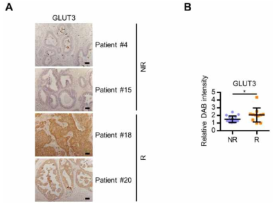 유방암 환자 조직에서 GLUT3의 발현 확인