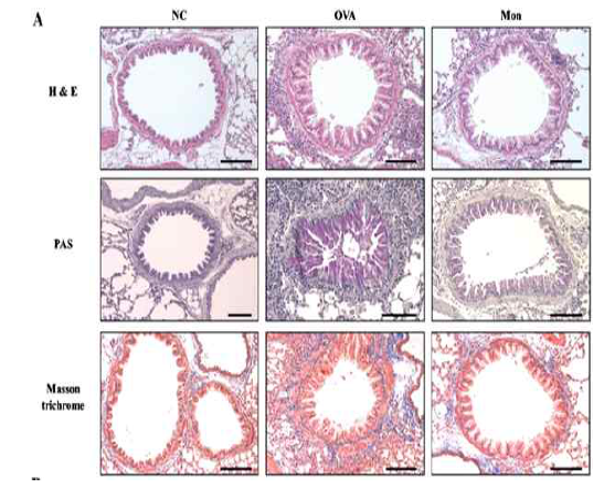 만성 천식 환자에서 Leukotriene antagonist사용 후 airway의 섬유화 반응이 감소한 것을 확인 할 수 있음