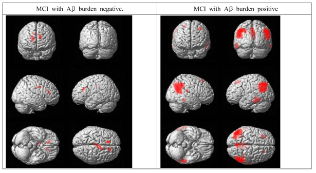 Brain areas with significant positive correlations between rCMglc and executive function in MCI with Aβ burden negative and aMCI with Aβ burden positive