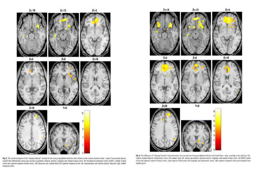 약물 중독 환자의 뇌 활성화(오른쪽)과 인터넷 게임 중독 환자의 뇌 활성화 (왼쪽)(Ko et al., 2009)
