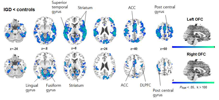 인터넷 게임 과의존군의 대조군 대비 FC에서의 뇌기능 연결성 변화