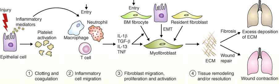 비정상적인 상처 치유과정이 폐 섬유화증을 유도함: 상처치유 과정의 4 단계: ① 혈액응고, ② 염증세포 유입, ③ 섬유아세포의 유입/증식/활성, ④ 조직 재형성 및 이완