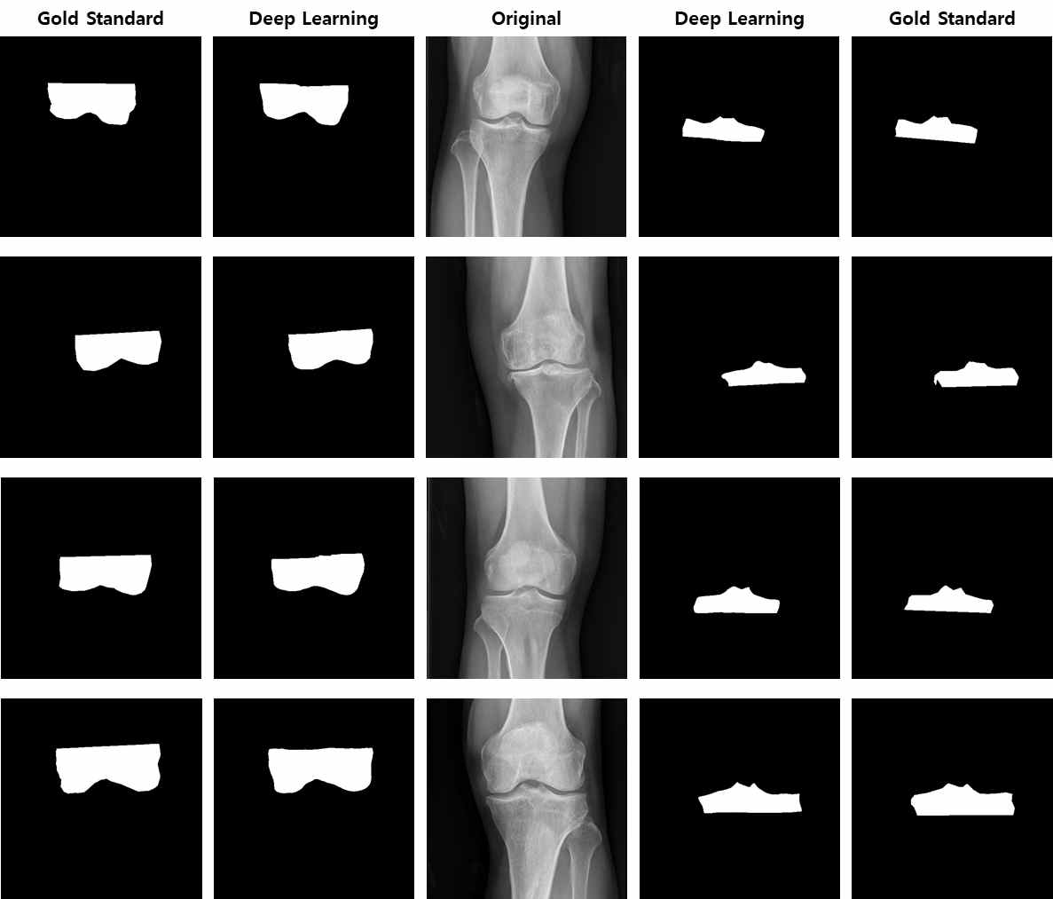 딥러닝 모델을 통해 분할된 Femur와 Tibia epiphysis 결과 비교