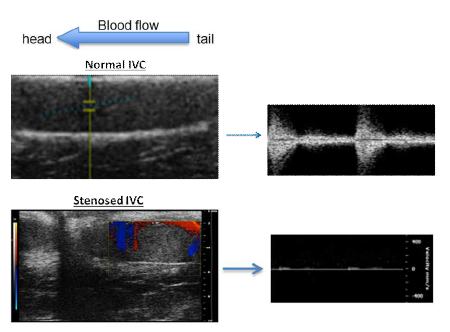 Ultrasound Flow Assessment of IVC Stenosis
