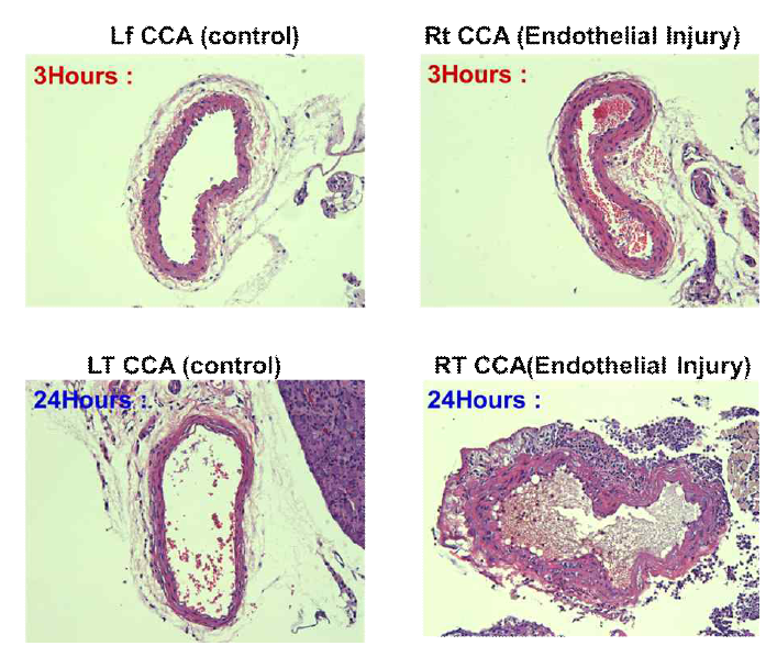 Histological staining of the carotid artery with (right) and without (left) stenosis