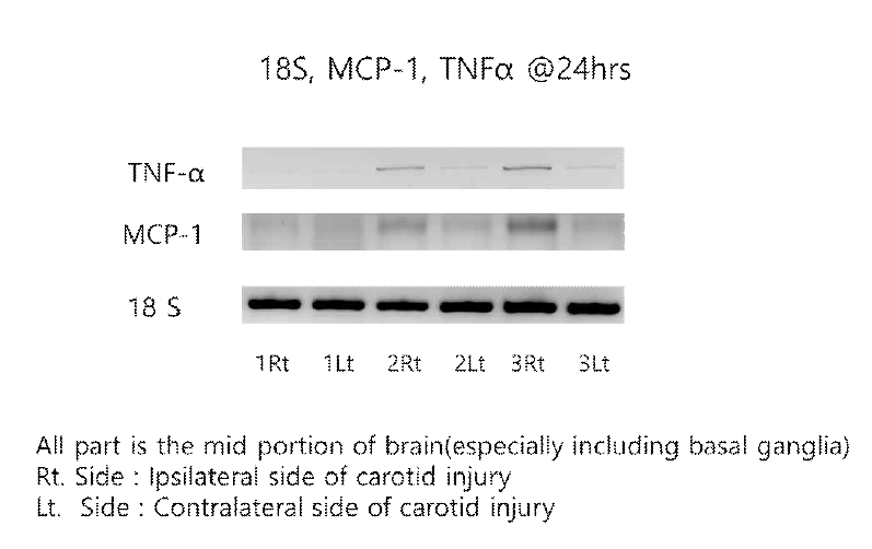 Expression of Inflammation Markers after Right Carotid Artery Injury in Brain