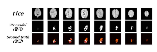 3D MRI 병변 특징 추출