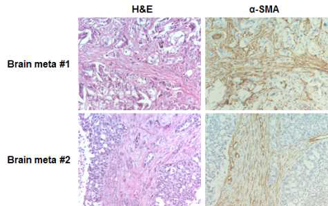 폐암 뇌전이 샘플의 α-SMA 면역염색