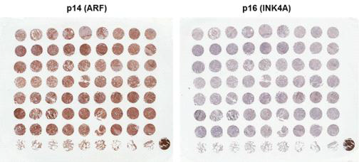 폐암의 TMA를 이용한 p14/ARF와 p16/INK4A 면역염색
