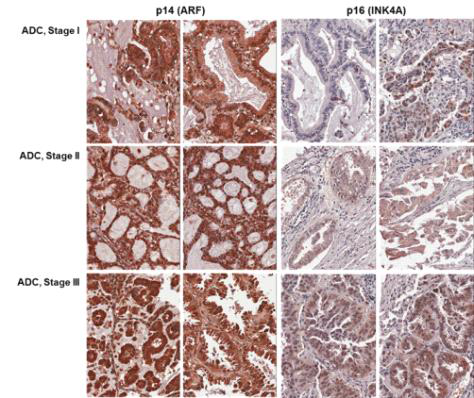 p14/ARF와 p16/INK4의 폐암 병기별 발현 양상