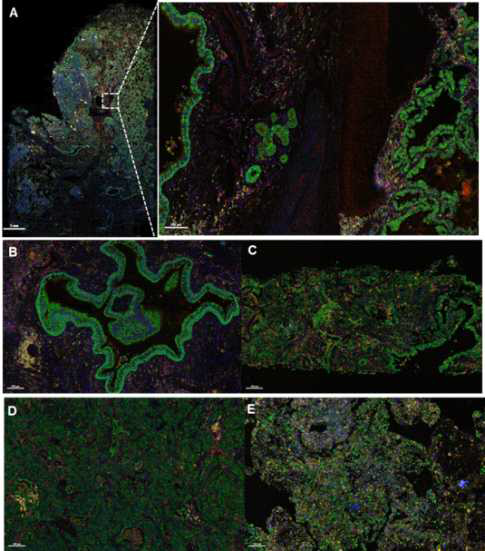 다중면역염색 (multiplexd IHC). A. Whole image, B-C. Adenocarcinoma, D-E. Squamous