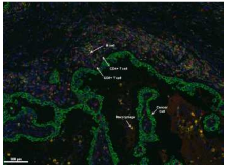 폐암 조직 내의 암세포와 면역세포