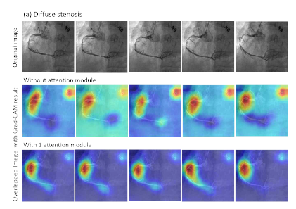 Grad-CAM을 이용한 심혈관 상태 판별 알고리즘의 해석 및 시각화