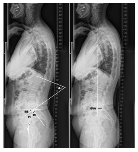엑스레이를 이용한 척추의 시상면 균형의 평가