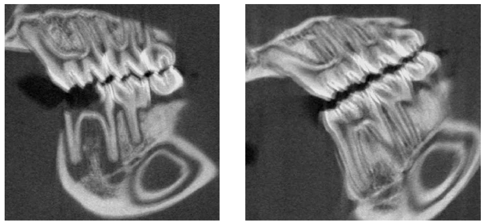 (좌) SD rat에서 periapical inflammation을 유도-3주. (우) 염증을 야기하지는 않는 control rat의 정상적인 apical CT image
