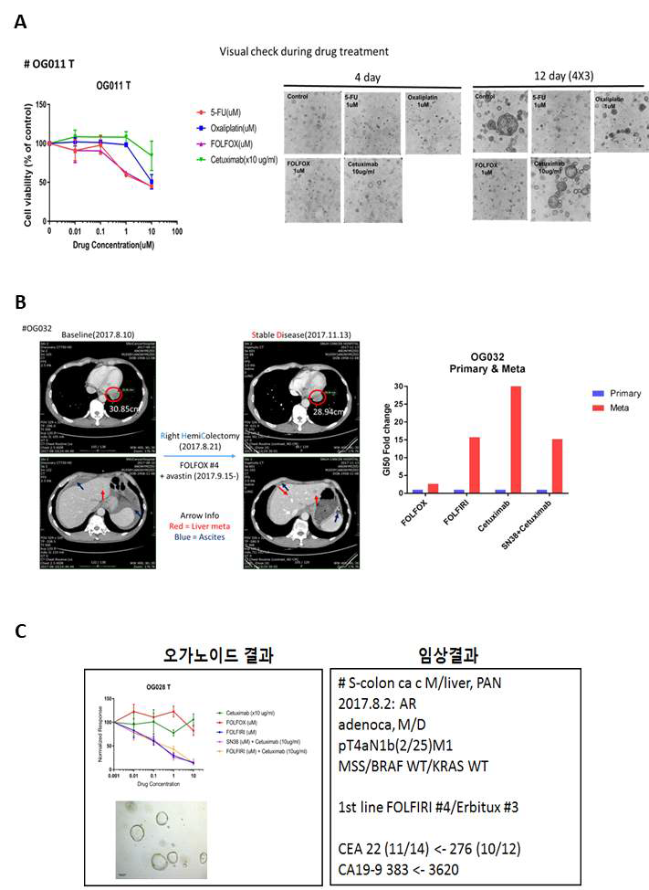 오가노이드 항암제 반응성 이중검증 및 환자에서의 항암제 반응성 양상 (A) 오가노이드 항암제 반응성 이중검증 (B) 전이된 대장암 환자 오가노이드의 항암제 반응성 양상 (C) 오가노이드와 동일환자 실제 임상결과