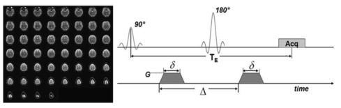 최적화된 DTI로 획득한 영상 및 DTI Sequence diagram