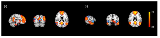 (a) 일반인과 (b) 다른 군간에 대표적인 뇌기능회로망 중 하나인 default mode network (DMN) 차이를 나타낸 그림. 붉은색은 각 집단에서 average correlation matrix로 구한 뇌기능회로망을 나타내며, 파란색은 각 집단에서 뇌기능회로망 연결성이 증가된 부분을 나타냄