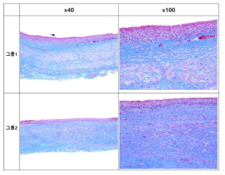 Masson-Trichrome stain한 피막의 40배와 100배 배율의 현미경 사진