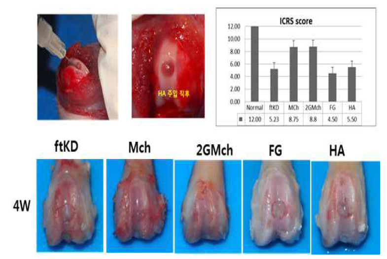 2세대 미세골절술과 하이얼루로산 주입에 대한 ICRS 평가