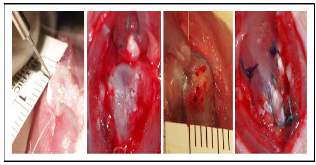 0.5mm 의 다발성 채널링 기구를 이용한 다발성 채널링 suture bridge 회전근개 복원 모델