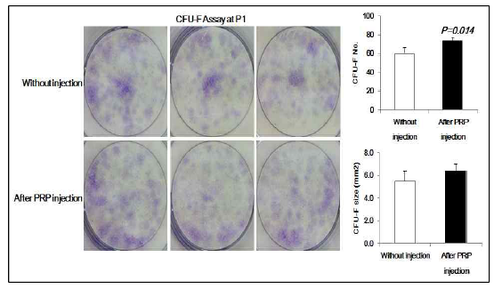 혈소판풍부혈장 복합체를 투여하기 전과 투여한 후 환자로부터 채취한 골수세포의 계대배양을 한 후(P1) 섬유모세포-집락 형성 단위 분석 (CFU-F assay)