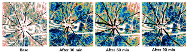 설치류 망막 및 맥락막 혈관조영 OCT를 통해 이미징한 렛 패혈증 모델의 맥락막 혈류속도 이미지. Baseline 이미징 직후 패혈증을 유발한 뒤, 30분 간격으로 OCT 이미징을 진행함. Baseline과 비교할 때, 혈류속도가 감소함을 알 수 있음
